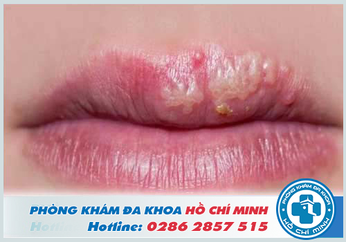 Đặc điểm vết bệnh Herpes ở môi