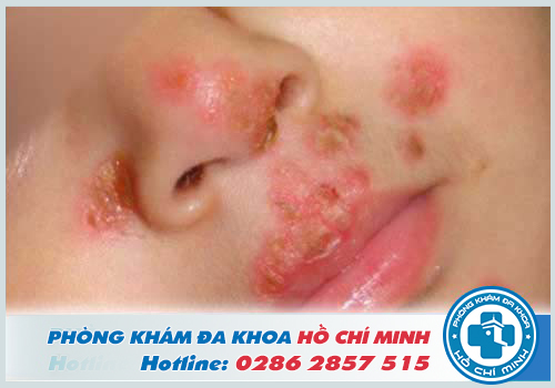 Hình ảnh Herpes sinh dục chủng 1 lây nhiễm tại vùng miệng, mũi