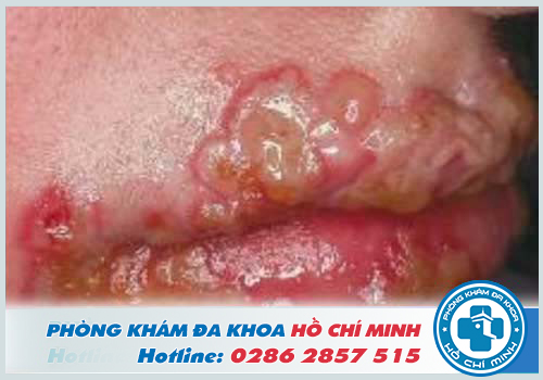Hình ảnh Herpes tàn phá vùng da ở miệng
