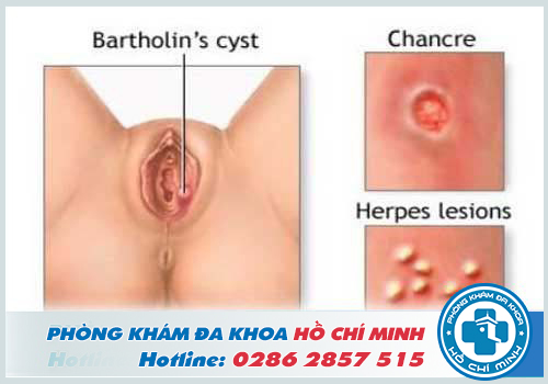 Viêm tuyến bartholin là bệnh phụ khoa thường gặp