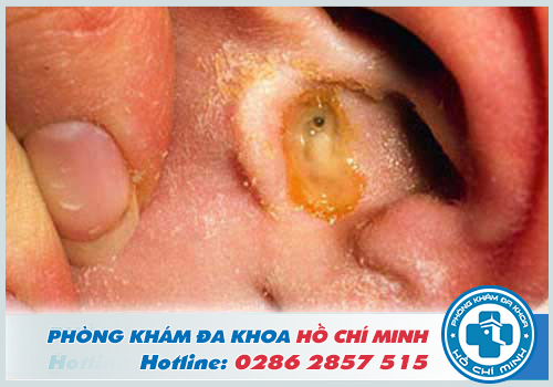 Viêm tai giữa có thể gây thủng màng nhĩ ở người bệnh