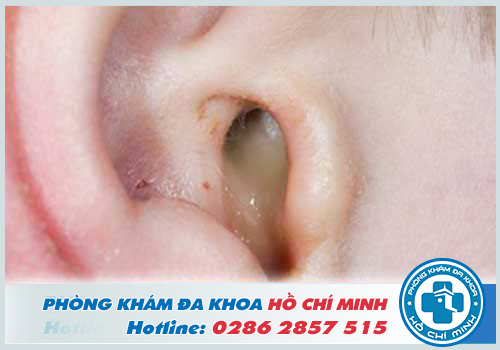 Đau nhức bên trong lỗ tai là bị viêm tai ngoài
