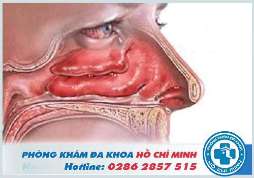 Polyp mũi là tình trạng xuất hiện một khối u lành tính trong hốc mũi