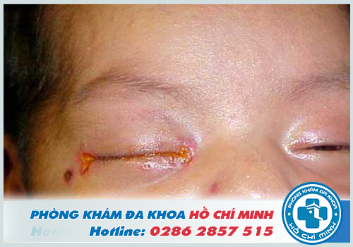 Hình ảnh bệnh lậu làm tổn thường mắt trẻ sơ sinh