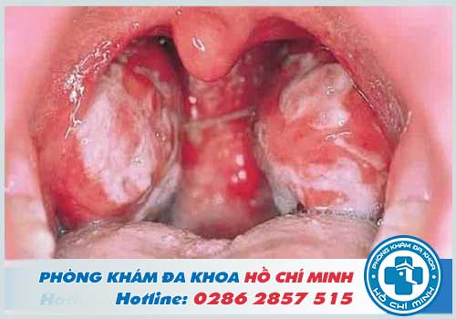 Hình ảnh bệnh lậu ở lưỡi, họng và mắt chi tiết nhất
