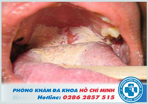 Hình ảnh bệnh lậu ở miệng qua từng giai đoạn gây hậu quả nghiêm trọng