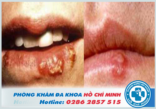 Hình ảnh vết bệnh Herpes ở miệng