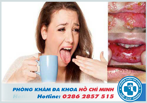 Hình ảnh herpes miệng và cách điều trị herpes miệng