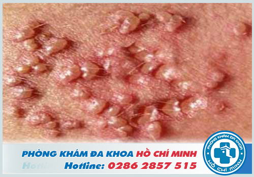 Bệnh mụn rộp sinh dục gây tổn thương nghiêm trọng lên vùng da