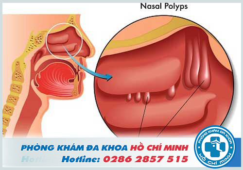 Bệnh poly mũi gây ra nhiều biến chứng nguy hiểm cho người bệnh