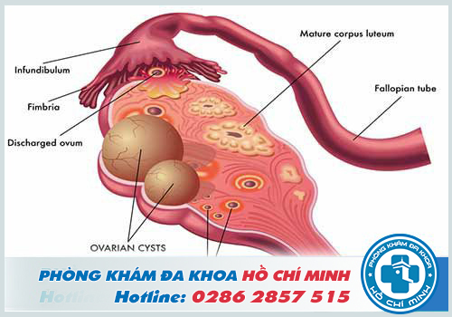 Mổ u nang buồng trứng bao lâu thì có thai được
