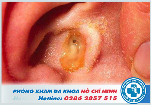 Viêm tai giữa gây ra nhiều triệu chứng khó chịu cho người bệnh